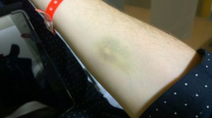 Bruise from removal from a small vein.