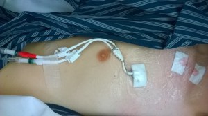 Central Hickman Catheter