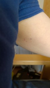 Petechiae pin pricks